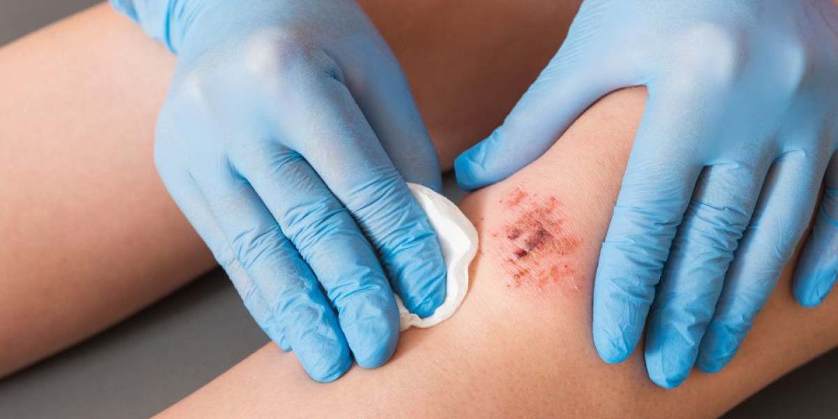 Comprehensive Wound Care in Oakland: From Assessment to Advanced Treatment Options