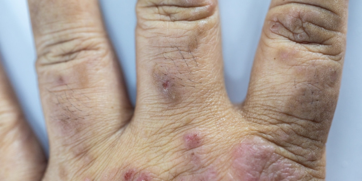 Imaging and Lupus: What You Should Know