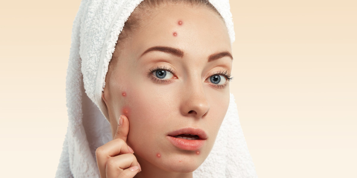 How Do Skin Doctors Determine Different Acne Treatments?