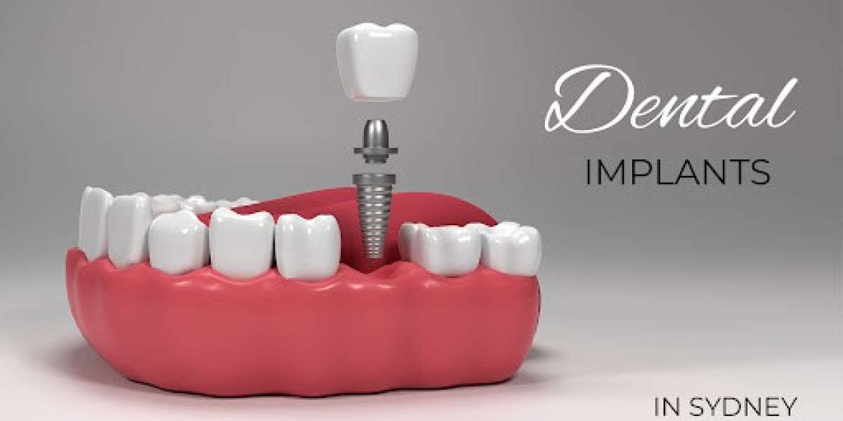 How Much Do Dental Implants Cost in Sydney