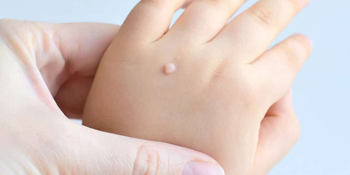 Best Choice for Warts: Laser Warts Removal Treatment?