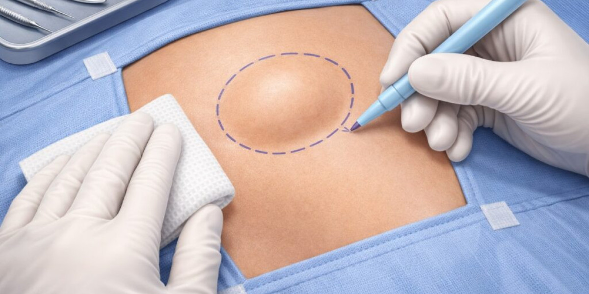 Lipoma Treatment Cost Explained for Beginners