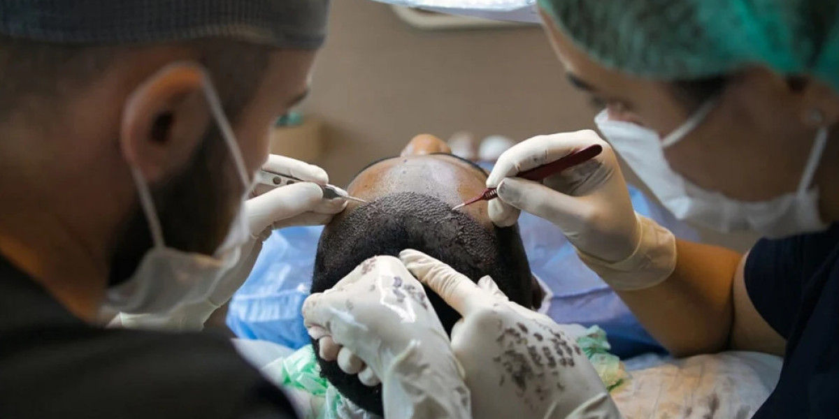 Preparing Your Scalp for Hair Transplant Surgery: Tips for Success