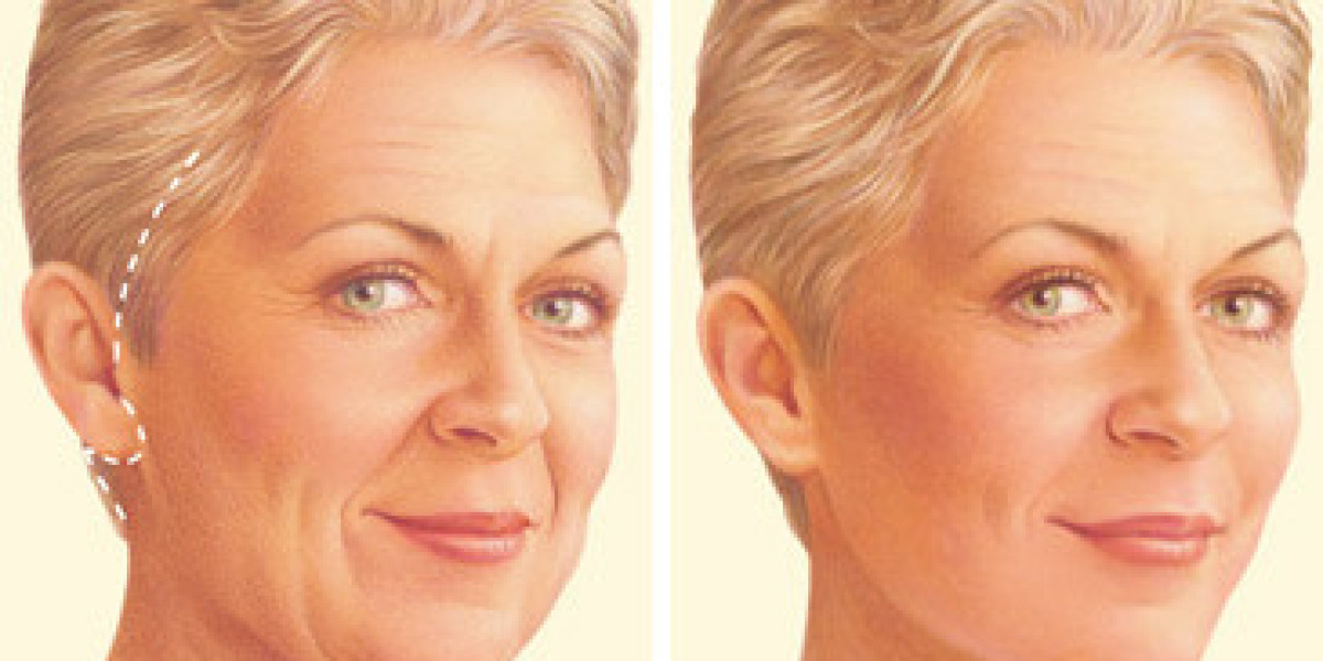 Endoscopic Forehead Lift at Blue Angel Poly Clinic: What It Feels Like When Your Face Stops Broadcasting Exhaustion