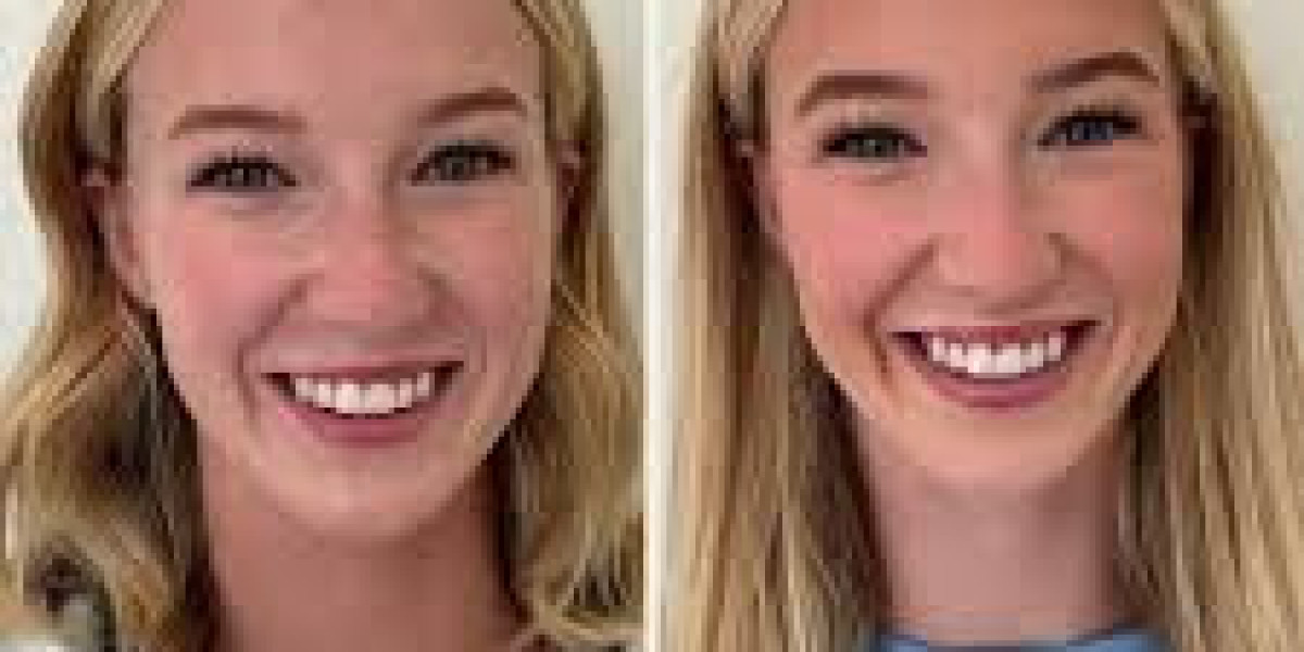 Lip Flip: Die Moderne Methode für Natürlich Volle Lippen