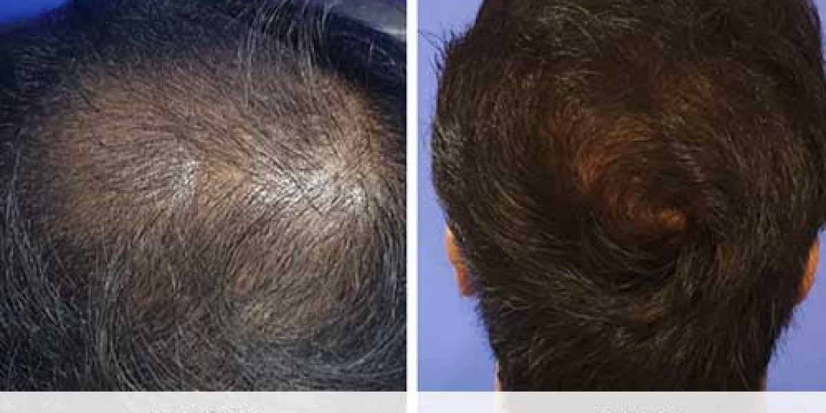 زراعة الشعر في دبي: استعيدي كثافة شعرك وأنوثتك