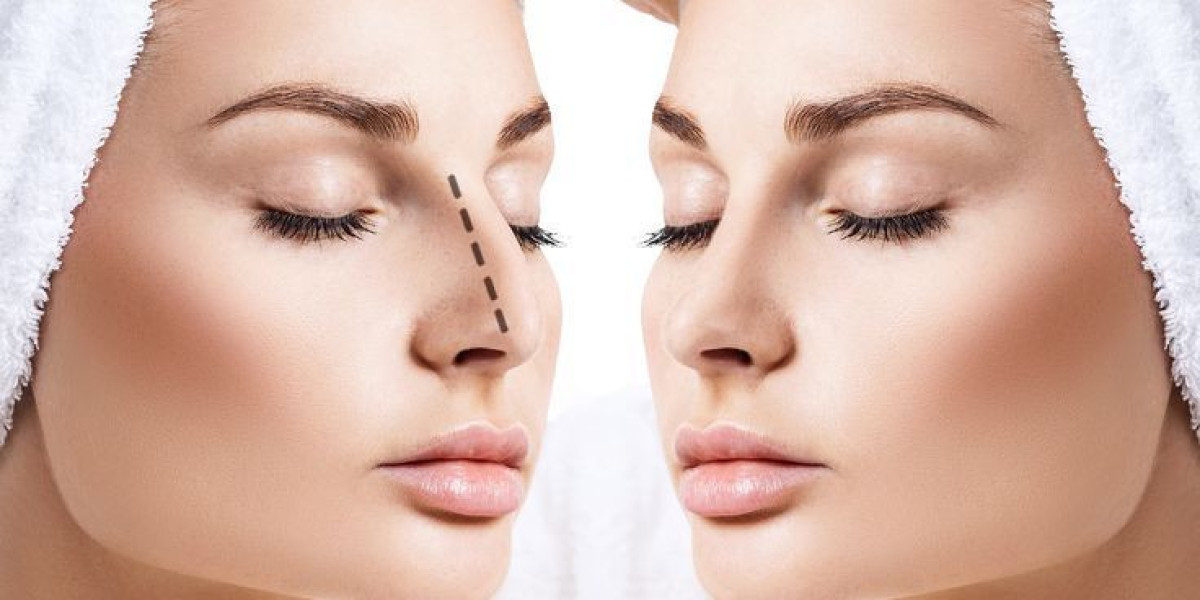 Rhinoplasty in Islamabad: Advanced Nose Surgery for Balanced Facial Features