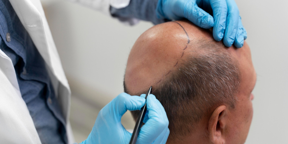 Hair Loss Treatment In Kokapet: Know Best Treatments, Cost, And More