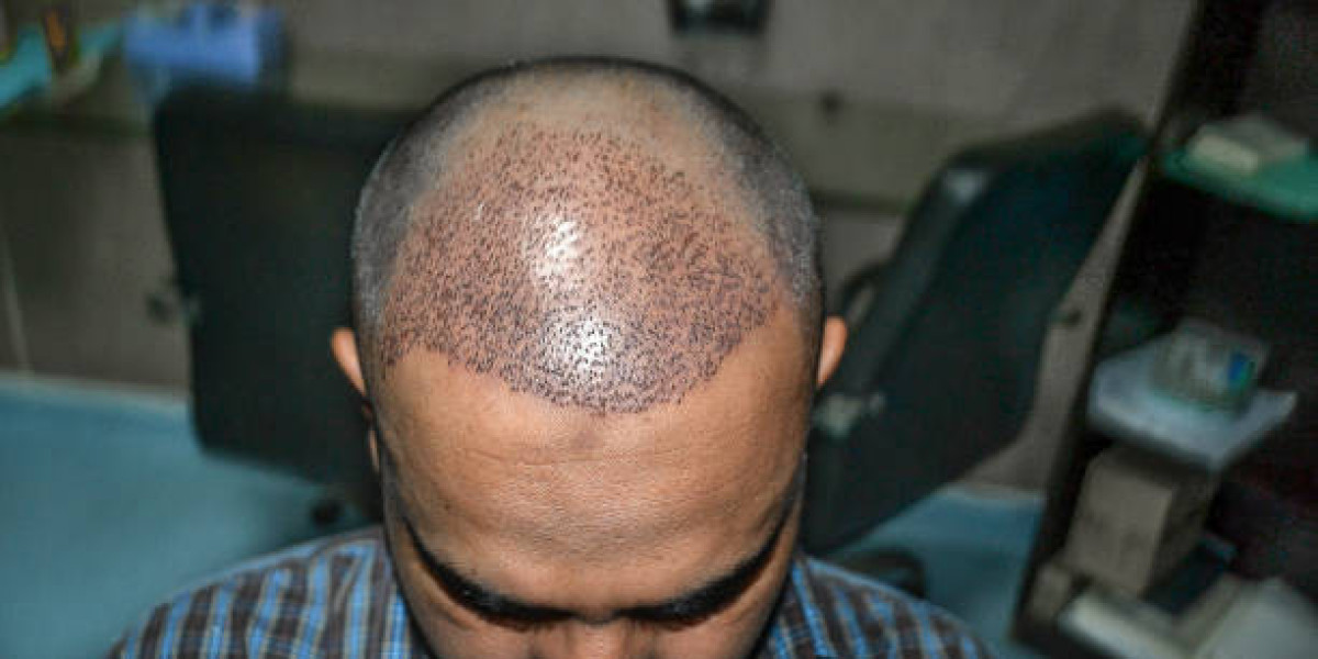 زراعة الشعر في دبي بتقنية الاقتطاف (FUE): دليل المبتدئين الشامل لعام 2026