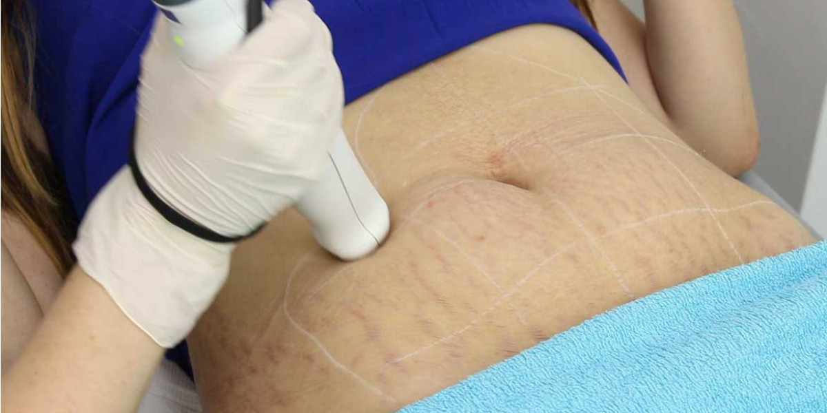 Laser Stretch Marks Treatment for Teen Stretch Marks