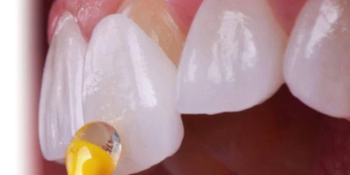 E-Max Veneers unlock premium aesthetic smile transformation