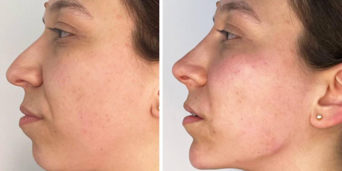 Endoscopic Forehead Lift in UAE: What It Actually Feels Like at Blue Angel Poly Clinic