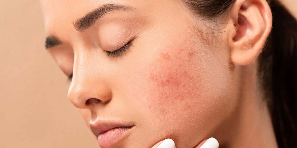 Is Large Pores Treatment Suitable for Sensitive Skin?