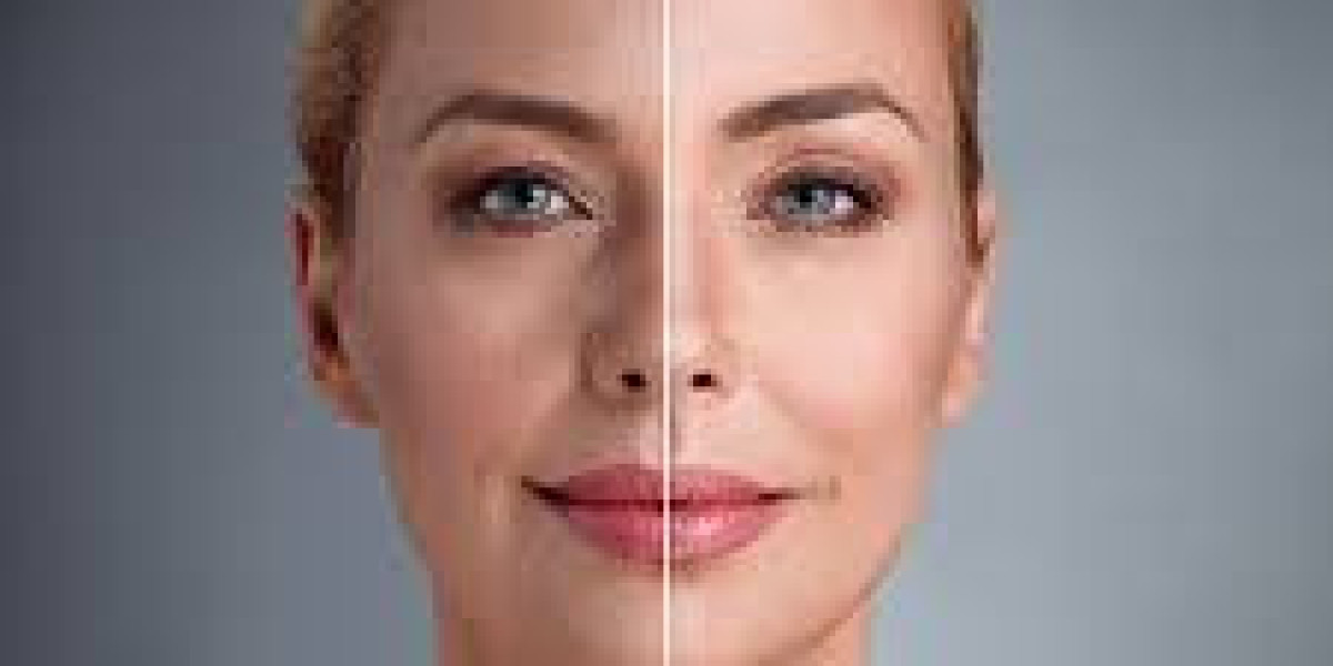 UltraClear Laser in UAE: A Fresh Start for Your Skin at Blue Angel Poly Clinic
