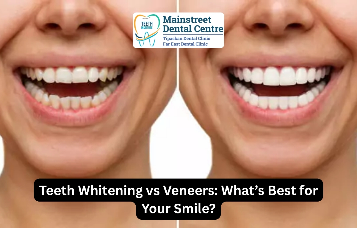 Teeth Whitening vs Veneers: What’s Best for Your Smile?