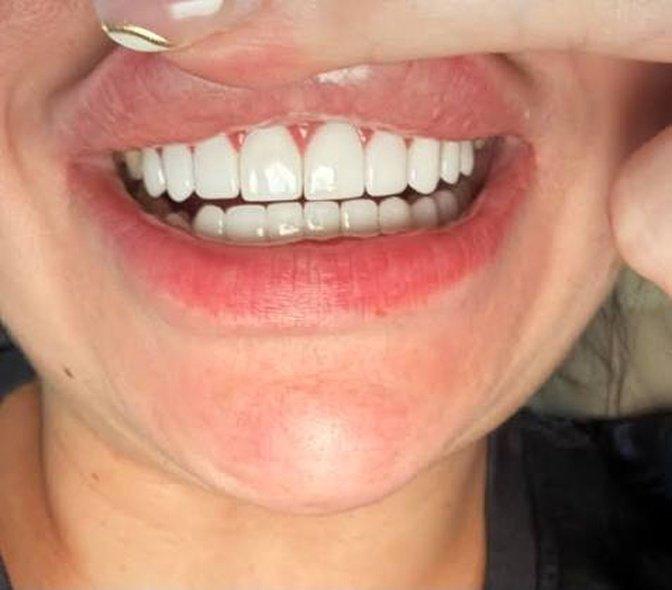 Can Veneers Fix Uneven, Short, or Worn-Down Teeth? | Articles | Oakheights Family Dental and Orthodontics | Gan Jing World - Technology for Humanity | Video & Movie Streaming