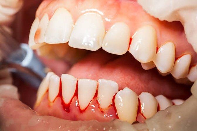 Why Do My Gums Bleed During a Dental Cleaning? | Articles | Kirkland Premier Dentistry | Gan Jing World - Technology for Humanity | Video & Movie Streaming