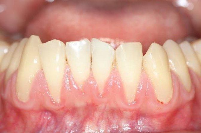 Can Gum Recession Grow Back Without a Gum Graft? | Articles | Tooth By Sunny Badyal | Gan Jing World - Technology for Humanity | Video & Movie Streaming