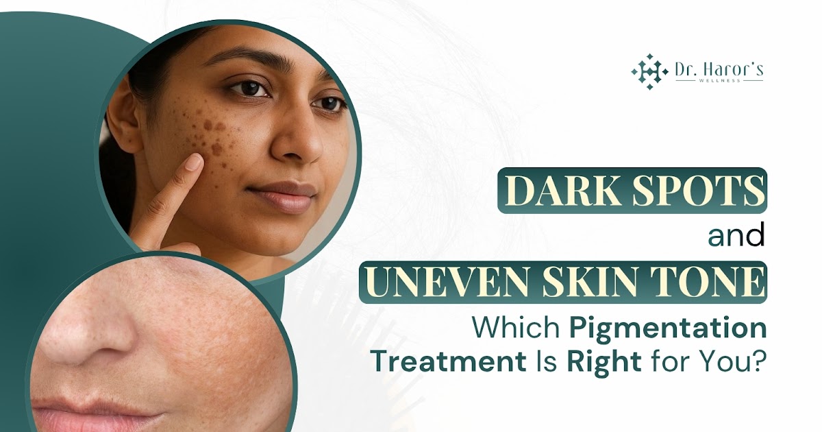 Dark Spots and Uneven Skin Tone: Which Pigmentation Treatment Is Right for You?